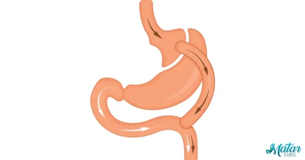 تحويل المسار الكلاسيكي والمصغر