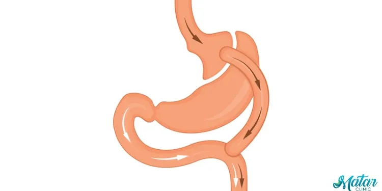 تحويل المسار الكلاسيكي والمصغر تحويل المسار الكلاسيكي والمصغر