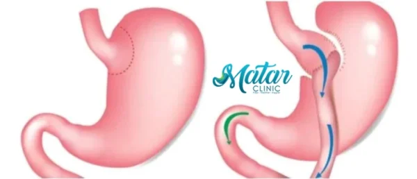 تحويل المسار المصغر تحويل المسار المصغر