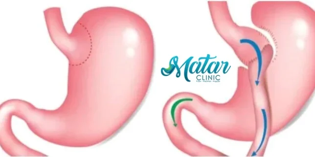 تحويل المسار المصغر تحويل المسار المصغر