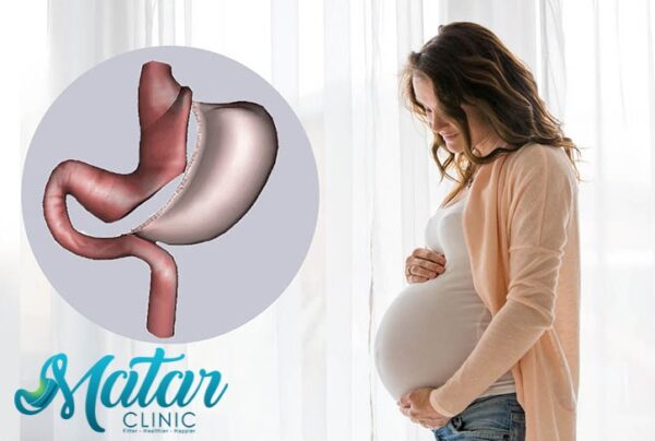 تكميم-المعدة-والحمل تكميم المعدة و الحمل