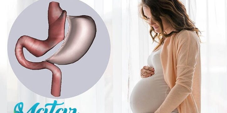 تكميم-المعدة-والحمل تكميم المعدة و الحمل
