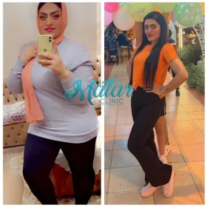 تجربتي مع تحويل مسار المعدة