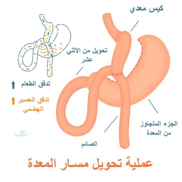 d01b941a-693a-11ed-9967-0050568b0c83 عملية تحويل مسار المعدة مع دكتور محمد مطر