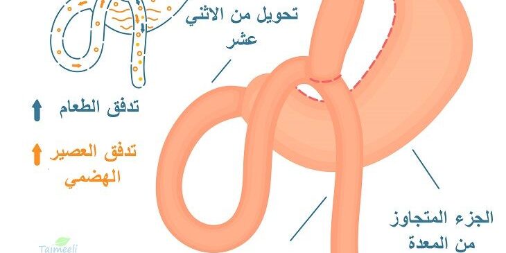 عملية تحويل مسار المعدة مع دكتور محمد مطر