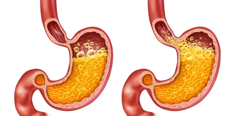 علاج ارتجاع المرئ