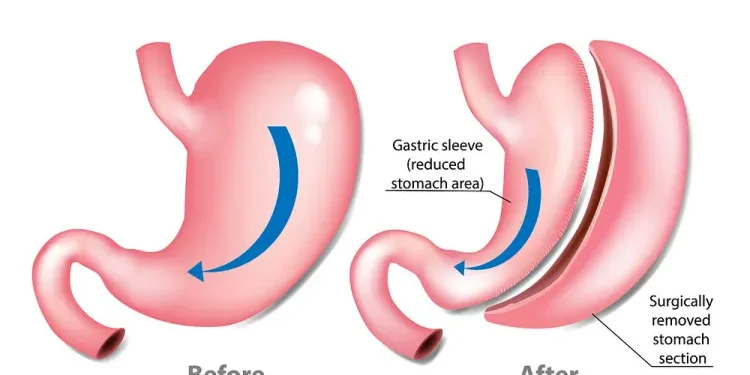التكميم المغلف