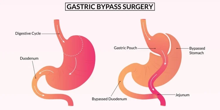عملية قص المعدة