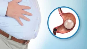 كبسولة تكميم المعدة