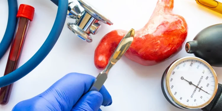 تجربتي مع عملية تكميم المعدة تجربتي مع عملية تكميم المعدة