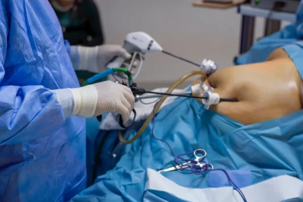 مميزات وعيوب عملية تكميم المعدة مميزات وعيوب عملية تكميم المعدة