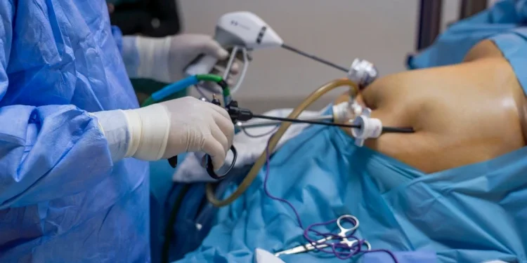 مميزات وعيوب عملية تكميم المعدة مميزات وعيوب عملية تكميم المعدة