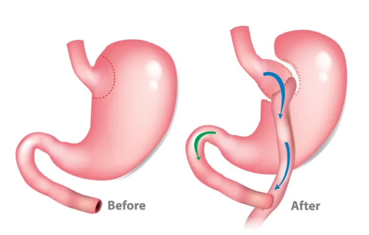 عملية-تحويل-مسار-المعدة عملية-تحويل-مسار-المعدة